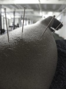 Dry Needling Acupuncture Glossop