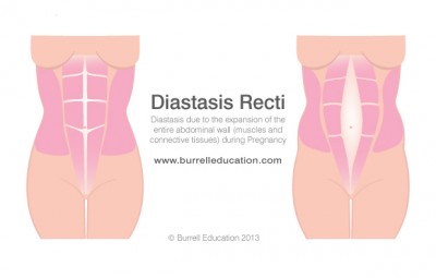 SPECIALIST TRAINING FOR BEFORE, DURING AND AFTER PREGNANCY Glossop Personal Training Diastasis Recti