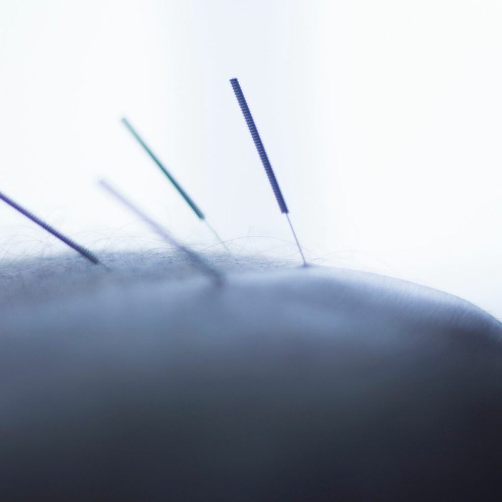 Dry Needling / Acupuncture